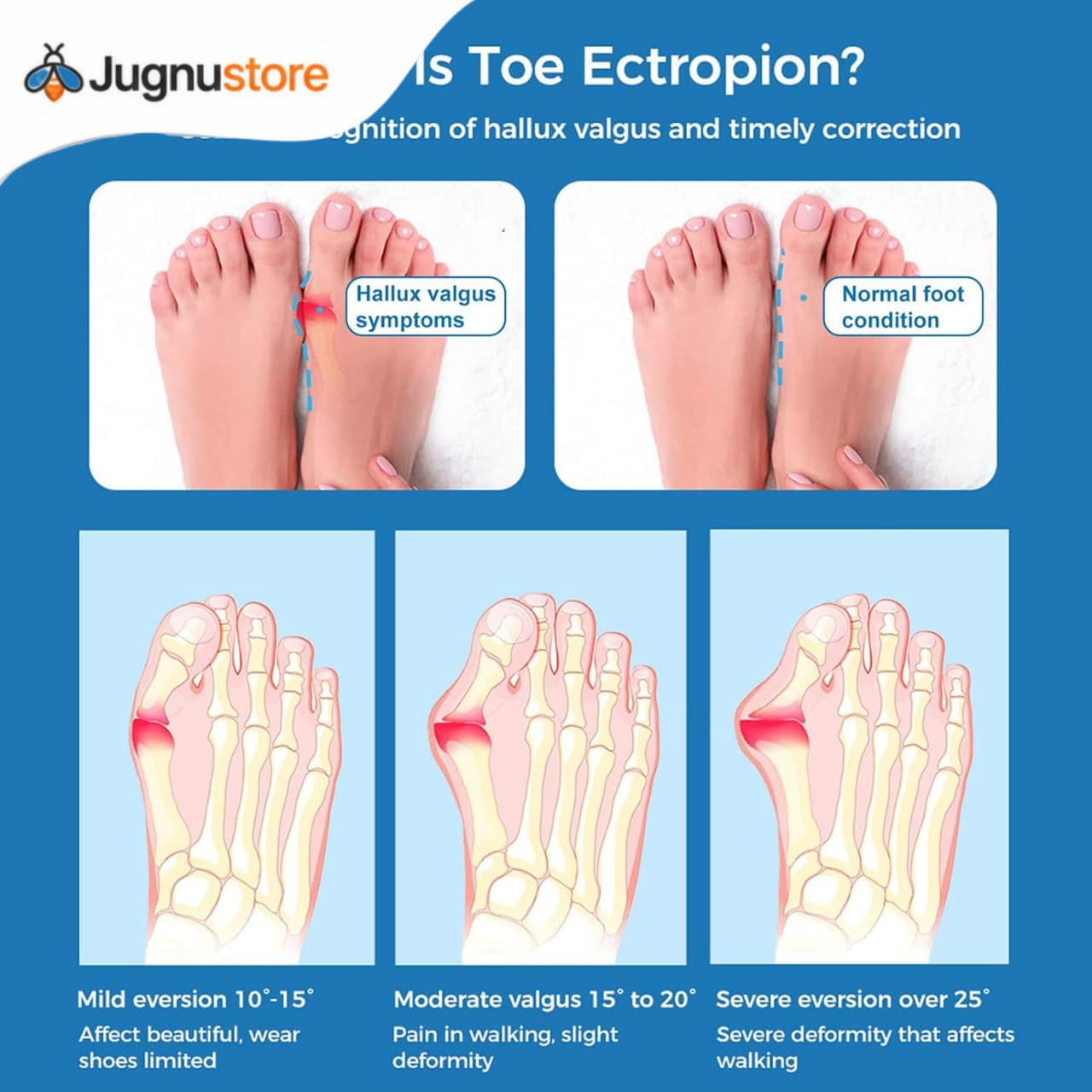 (Free Home Delivery) Pain Relief Bunion Toe Corrector